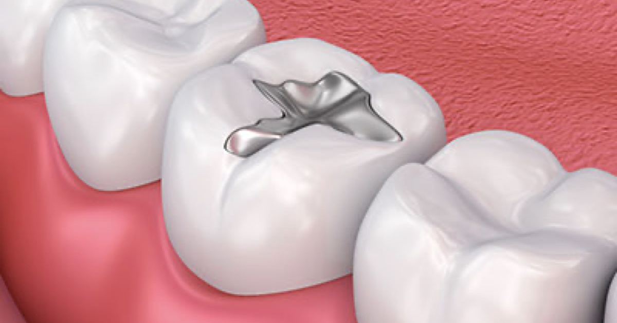 L’amalgama dentale: la precisazione della commissione CAO